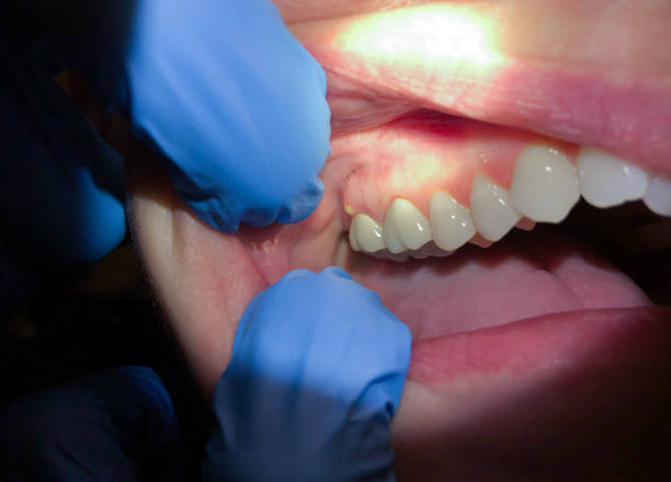 Best Chipped Tooth Repair Near Me  in New Athens, IL